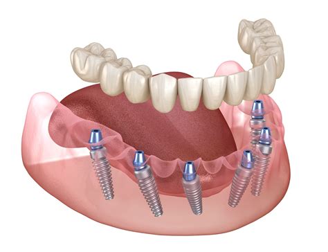 Full Mouth Dental Implants .